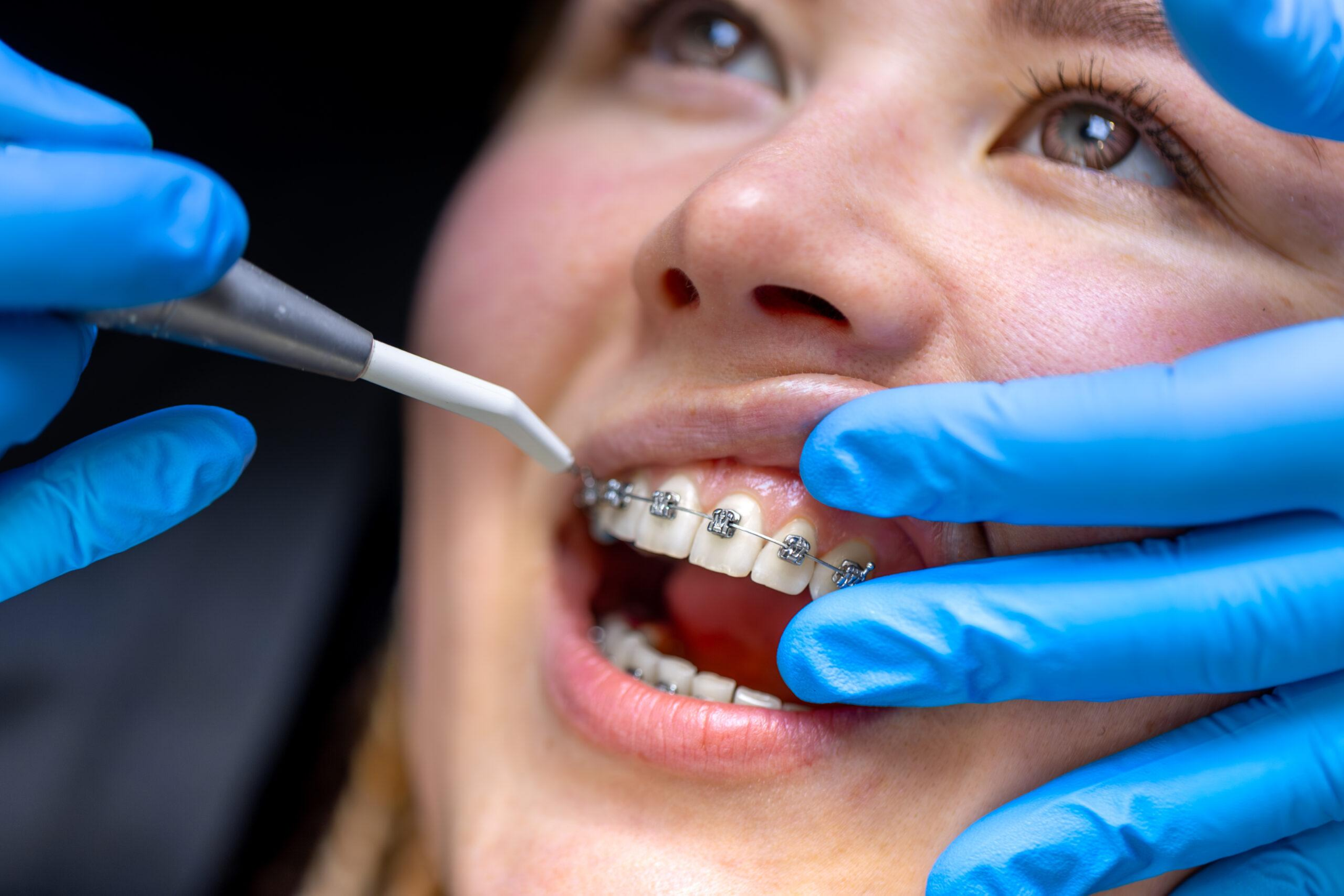 teeth braces