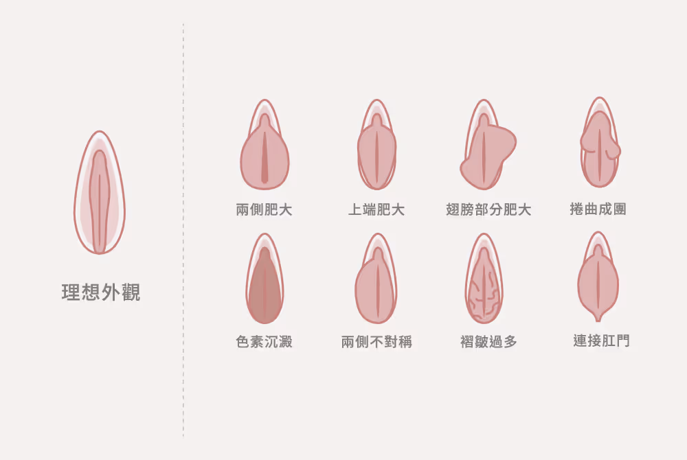 陰唇外觀