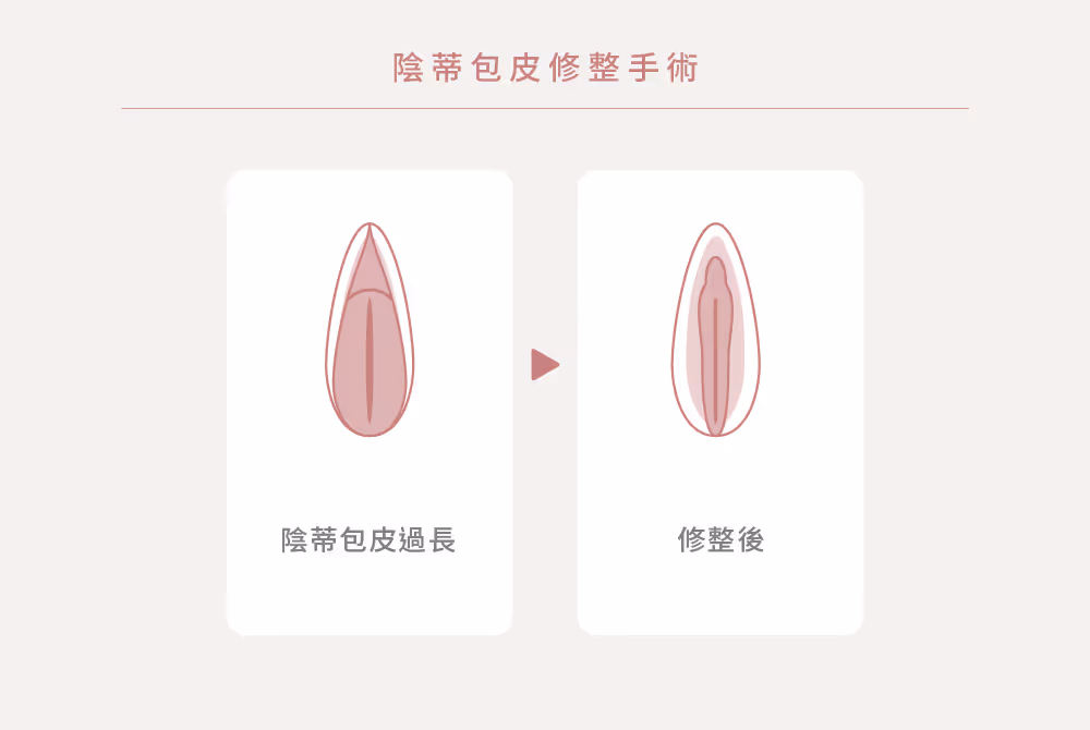 小陰唇減積手術