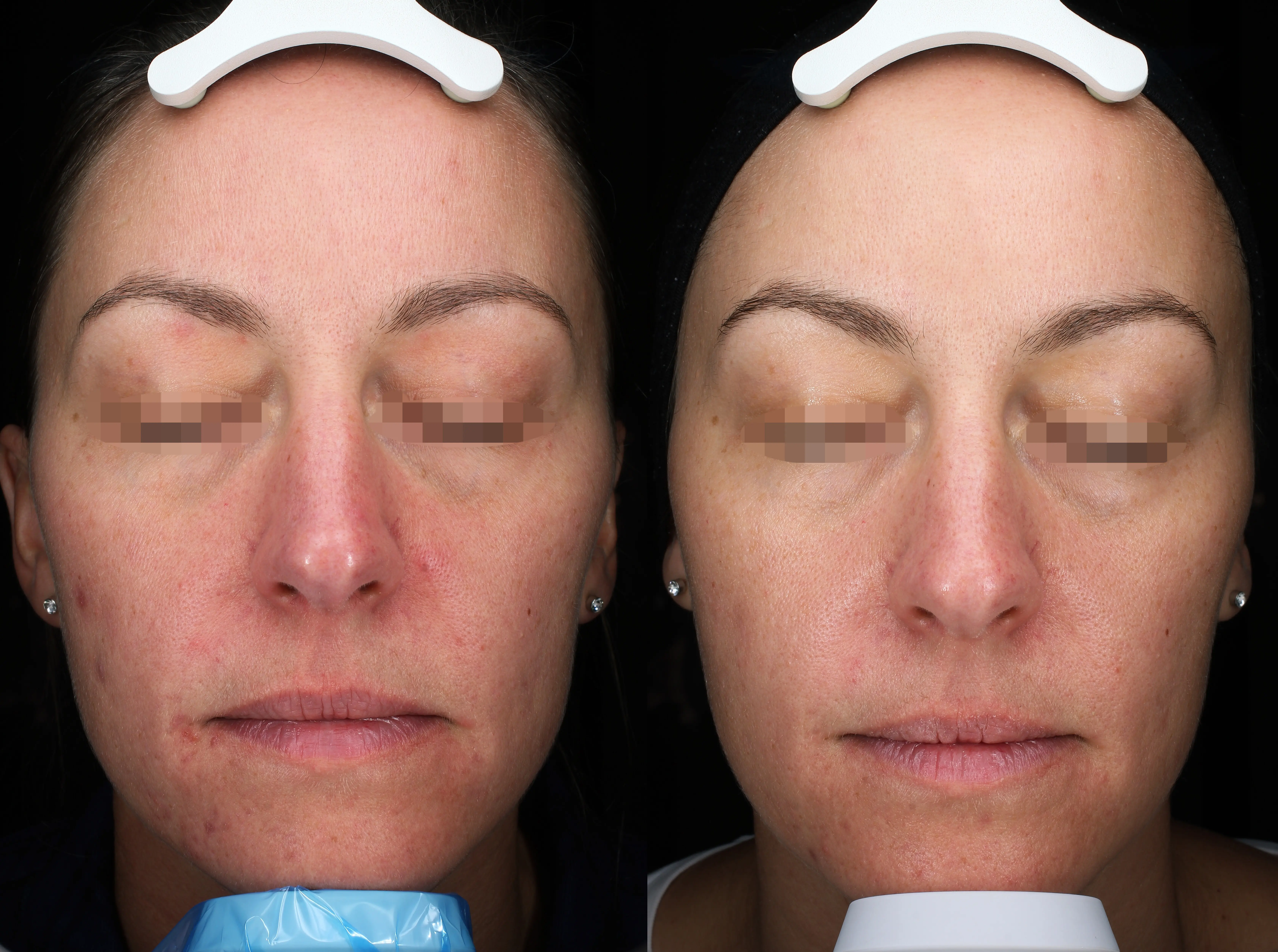 Side-by-side frontal close-up photos of a woman's face showing skin improvement with reduced redness and blemishes in the right image compared to the left.