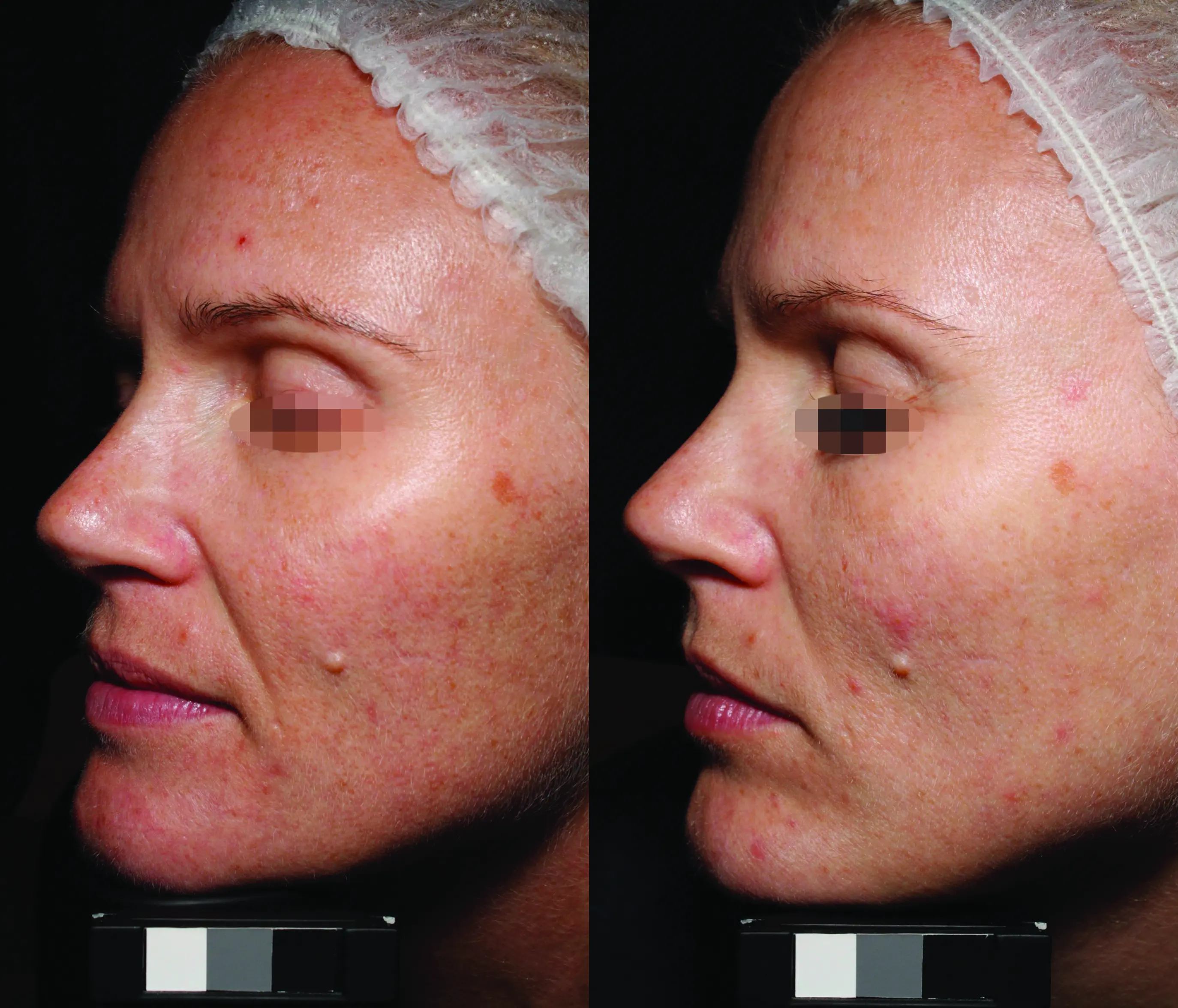 Side-by-side close-up comparison of a woman's cheek and jaw area showing mild acne and skin blemishes before and after treatment.