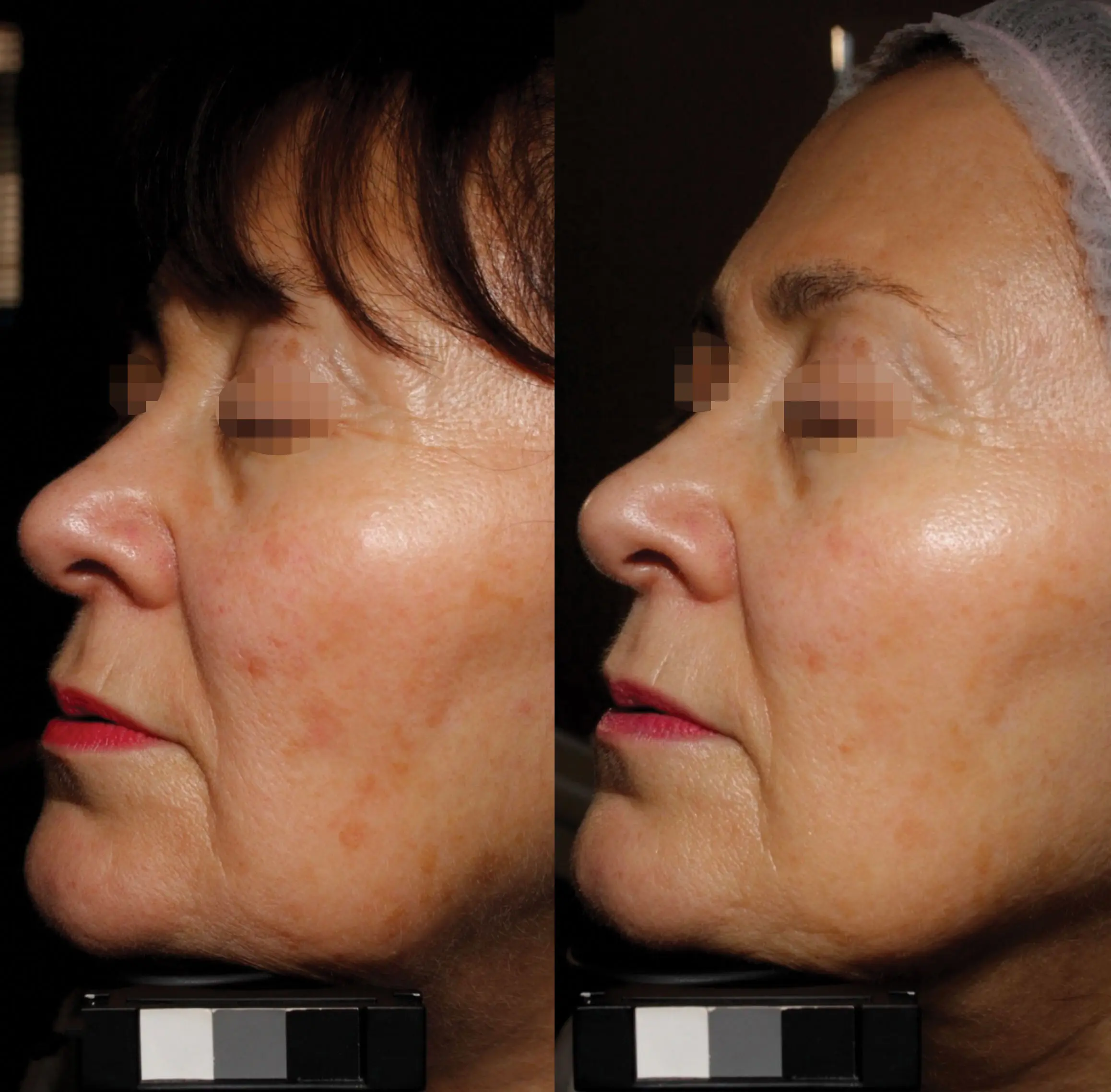 Side-by-side comparison of a woman's face showing reduced pigmentation and smoother skin texture in the after image.