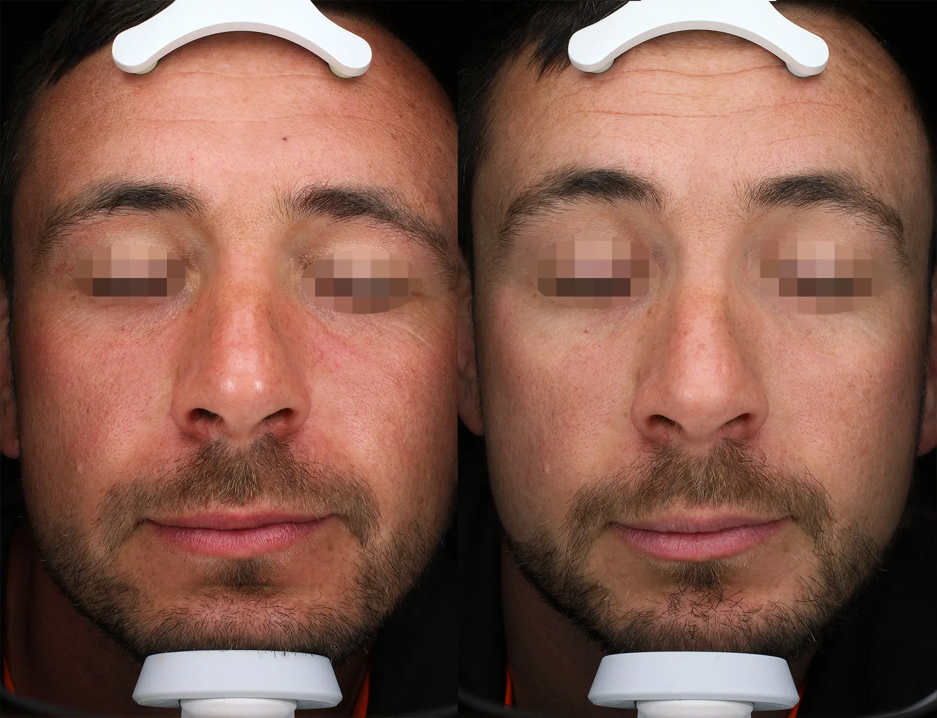 Side-by-side comparison of a man's face before and after skin treatment, showing smoother skin texture and reduced redness on the right.