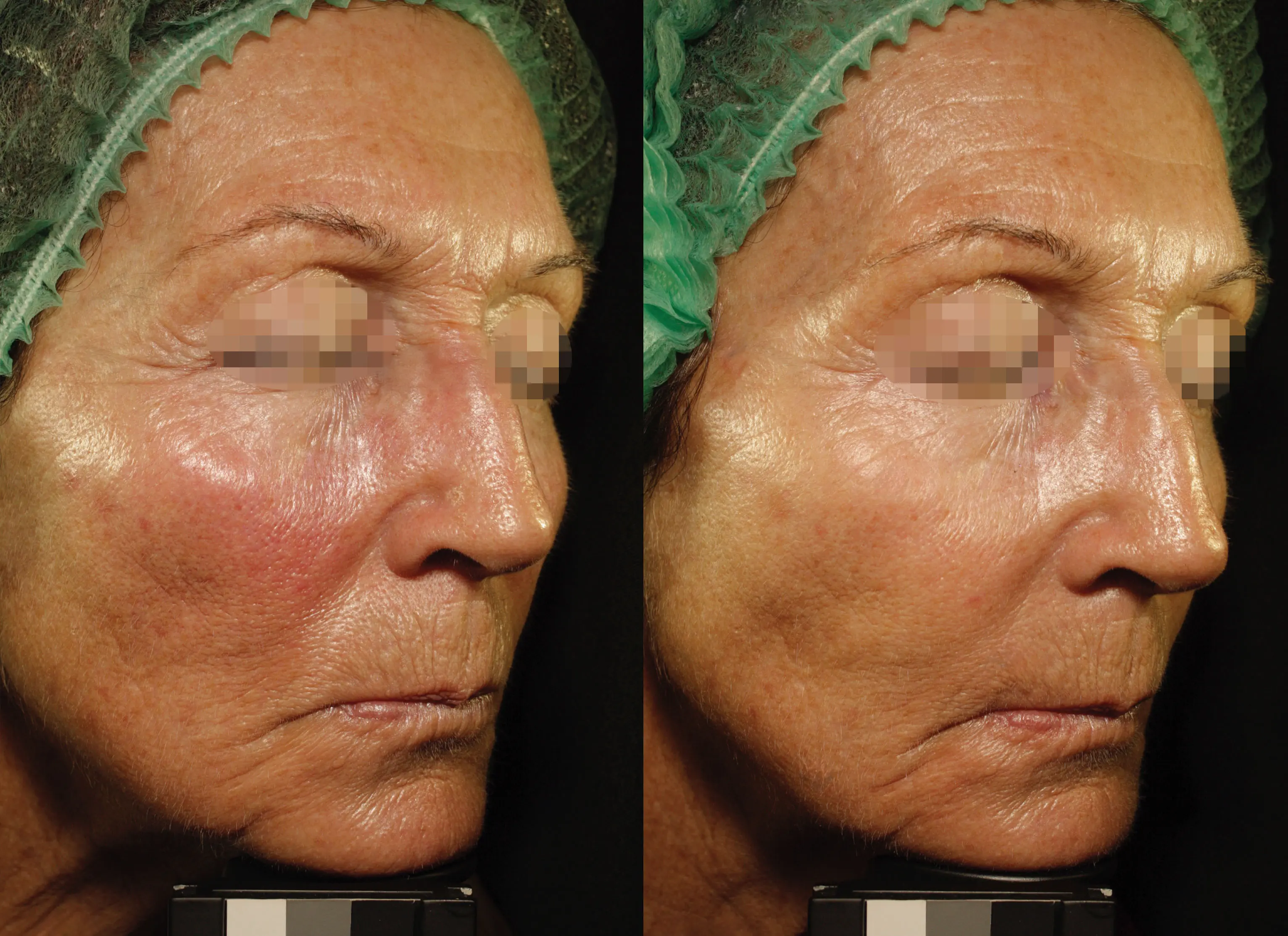 Close-up side-by-side comparison of a woman's face showing reduced redness and smoother skin texture on the right side after treatment.