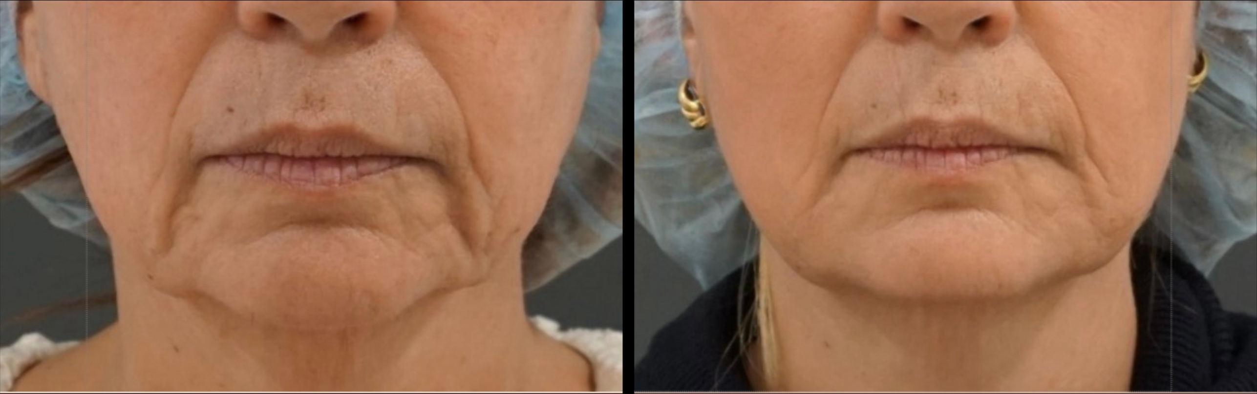 Side-by-side close-up comparison of a woman's cheek and jaw area showing mild acne and skin blemishes before and after treatment.