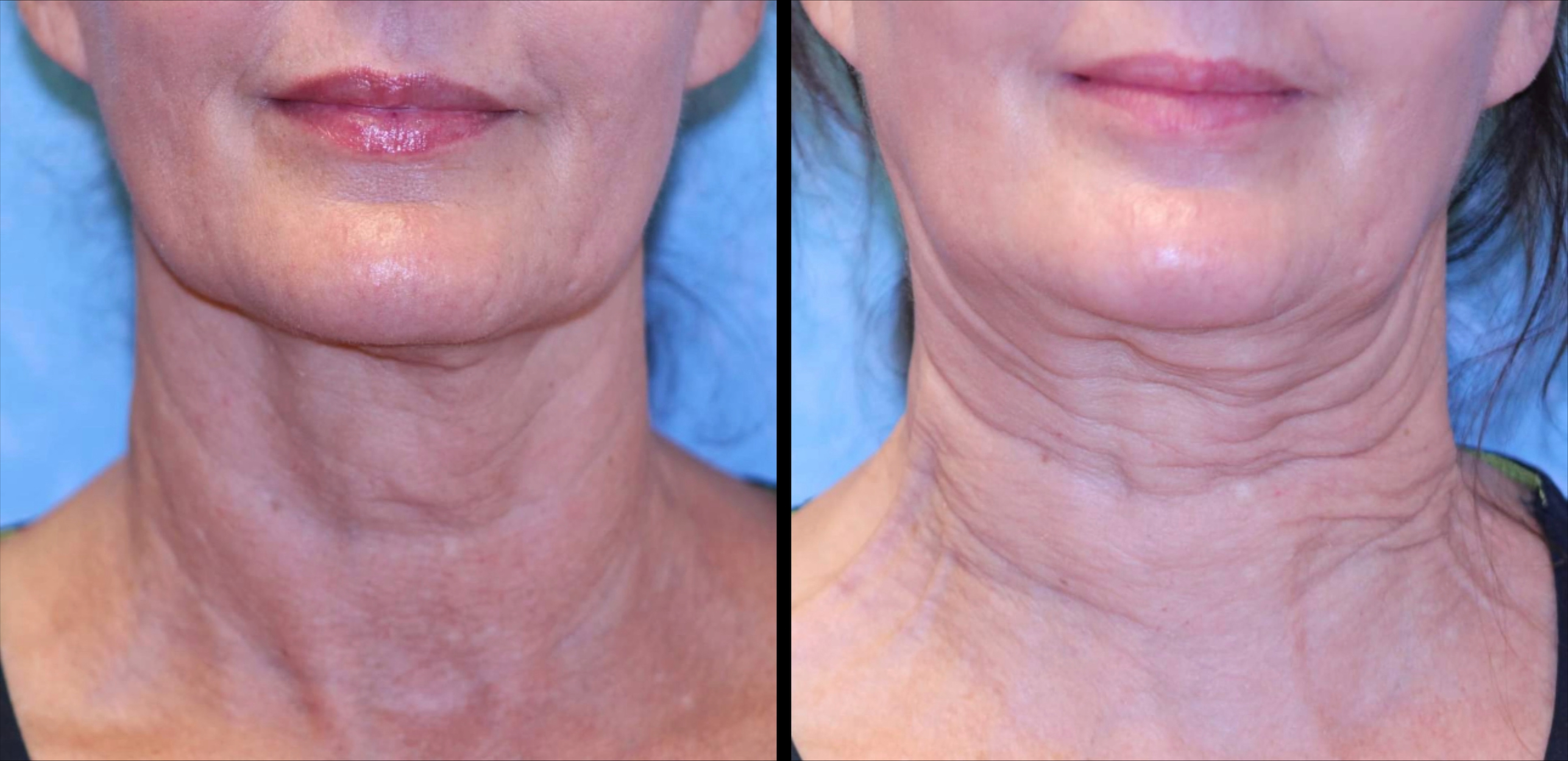 Side-by-side comparison of a woman's face showing reduced pigmentation and smoother skin texture in the after image.
