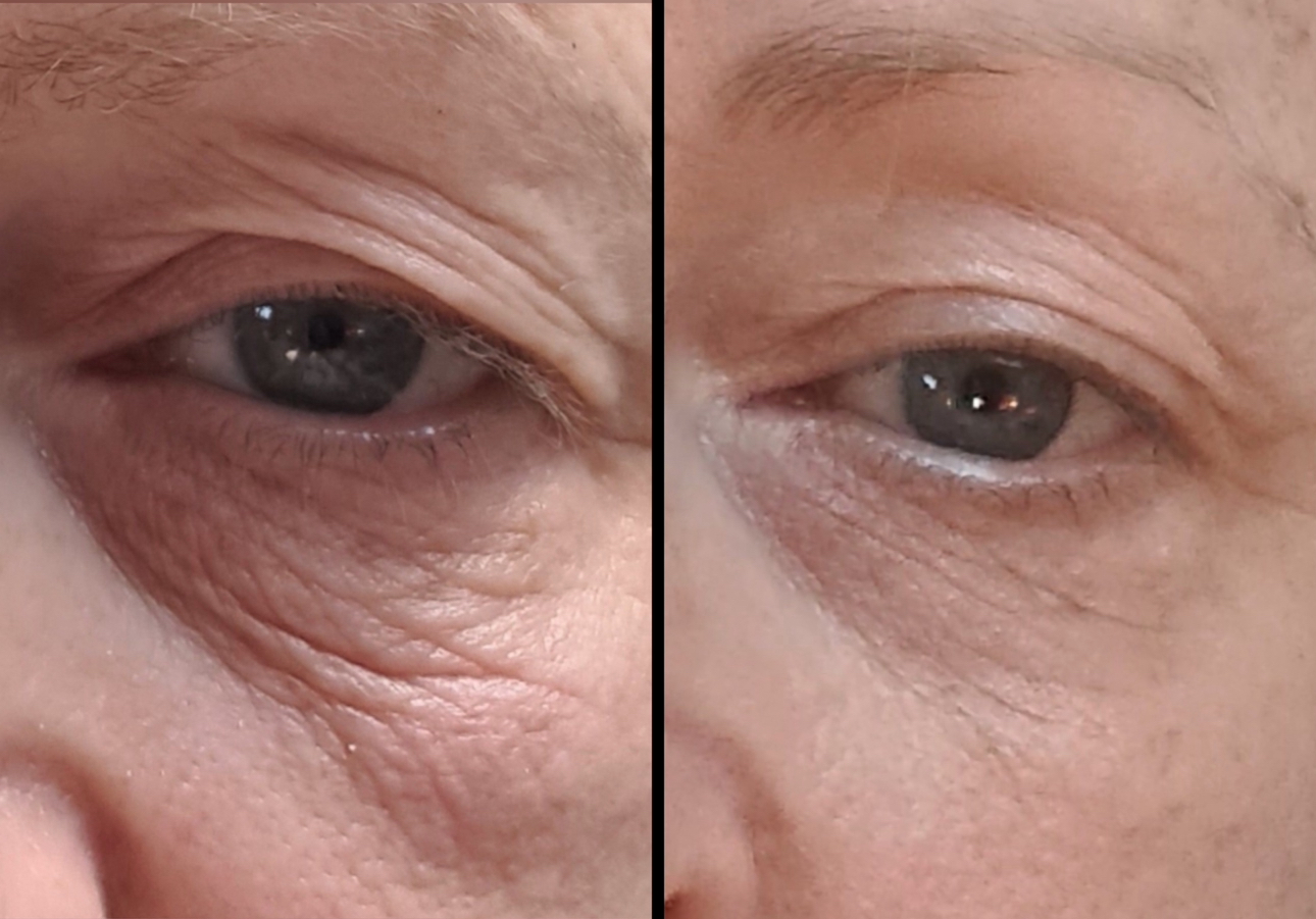 Side-by-side comparison of a man's face before and after skin treatment, showing smoother skin texture and reduced redness on the right.