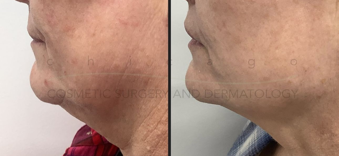 Close-up side-by-side comparison of a woman's face showing reduced redness and smoother skin texture on the right side after treatment.
