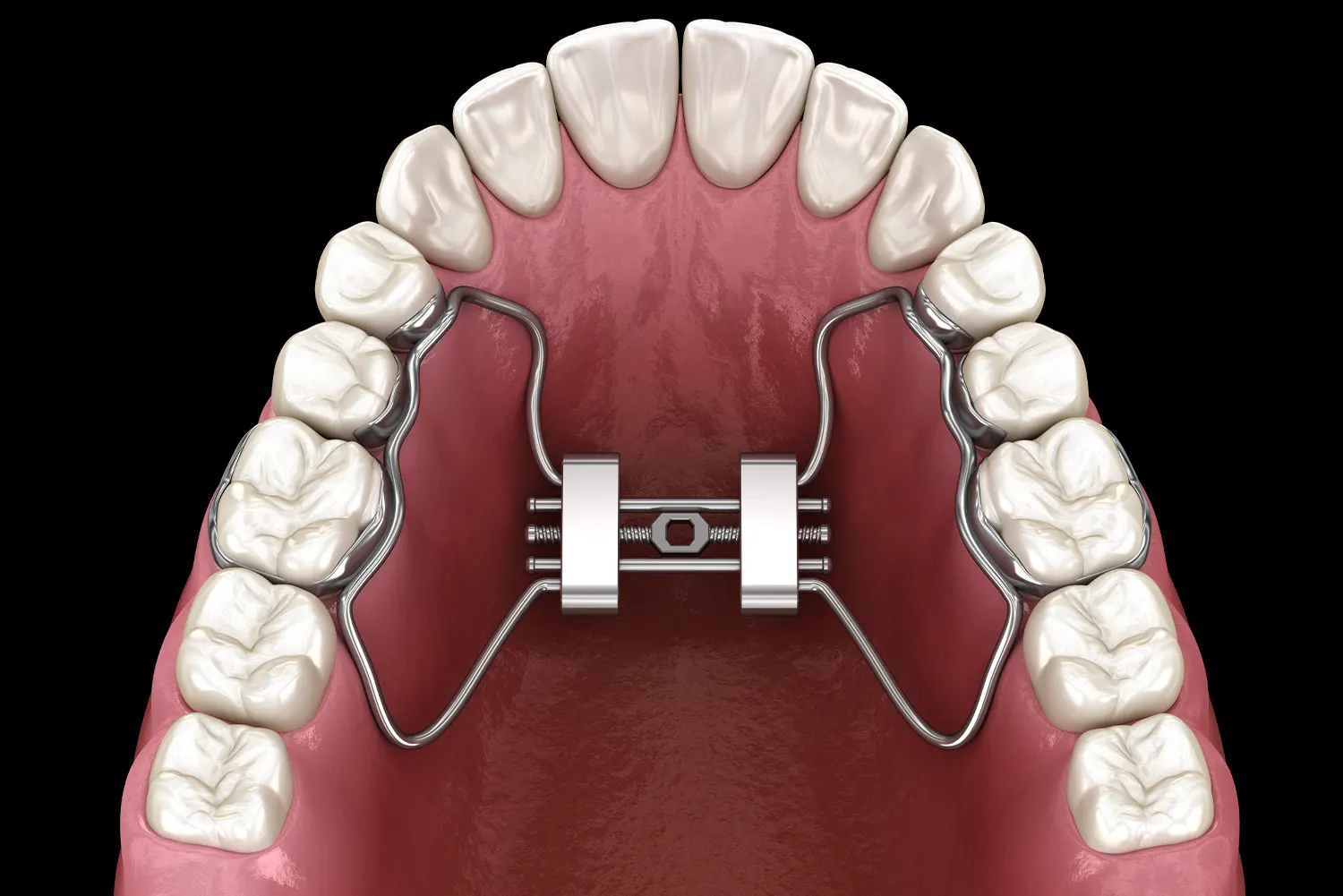 Palatal Expander in San Marino | San Marino Orthodontics