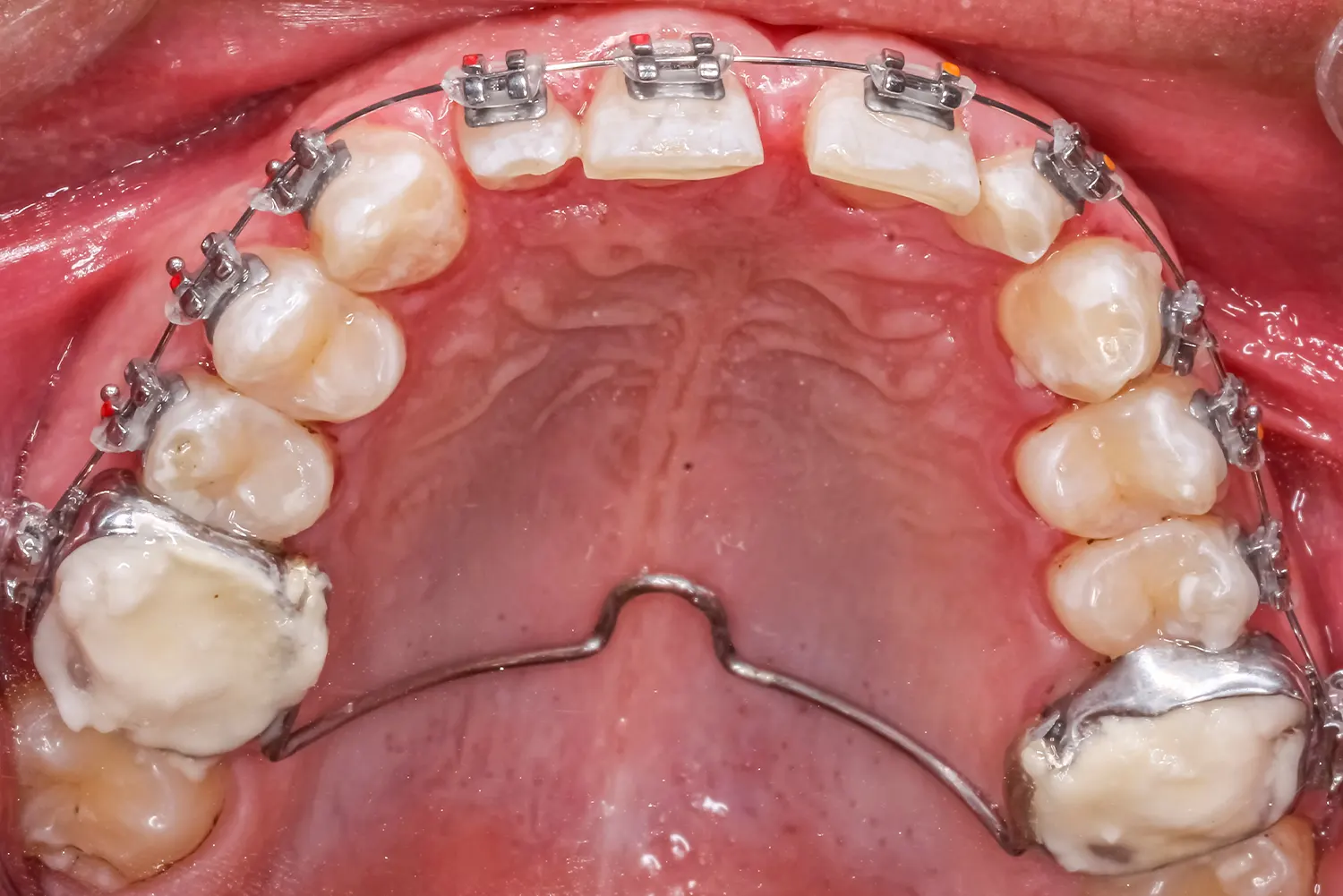 Palatal Expander in San Marino | San Marino Orthodontics