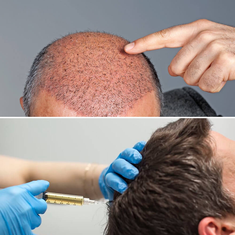 Patient receiving regenerative hair restoration treatment in Sandy Springs, Georgia, to improve thinning and support natural follicle health