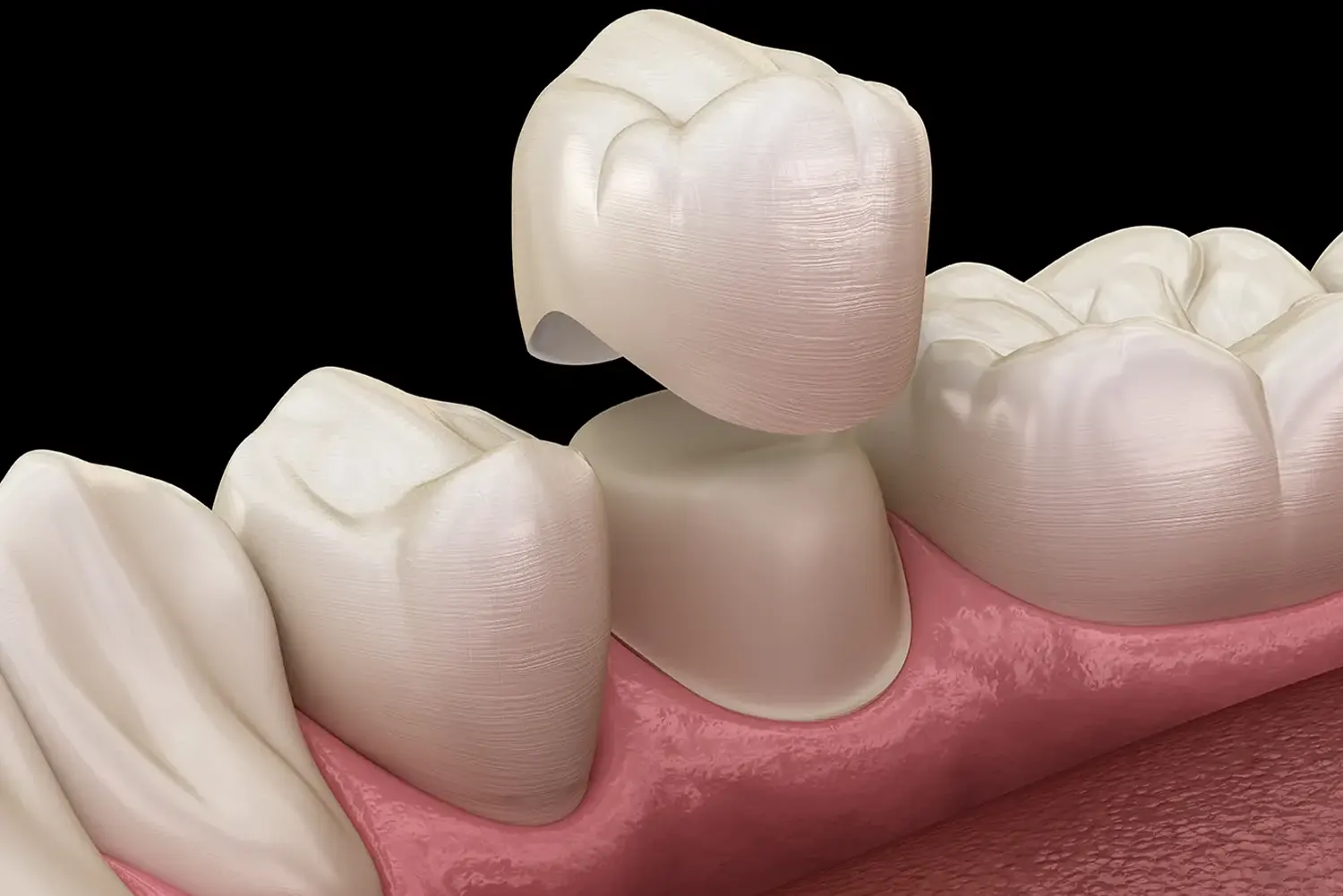 Dental Crowns in Culver City