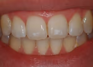 How to Treat White Spots on Your Teeth
