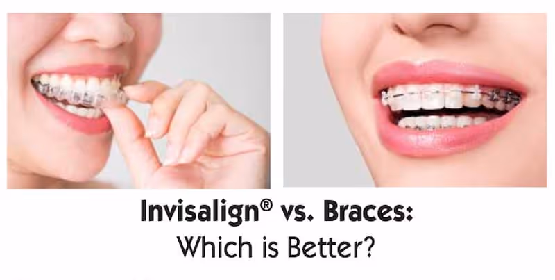 Invisalign vs. Braces – Which is Better for You?