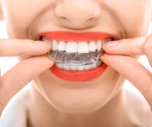 Invisalign for Patients: Pricing and Procedure