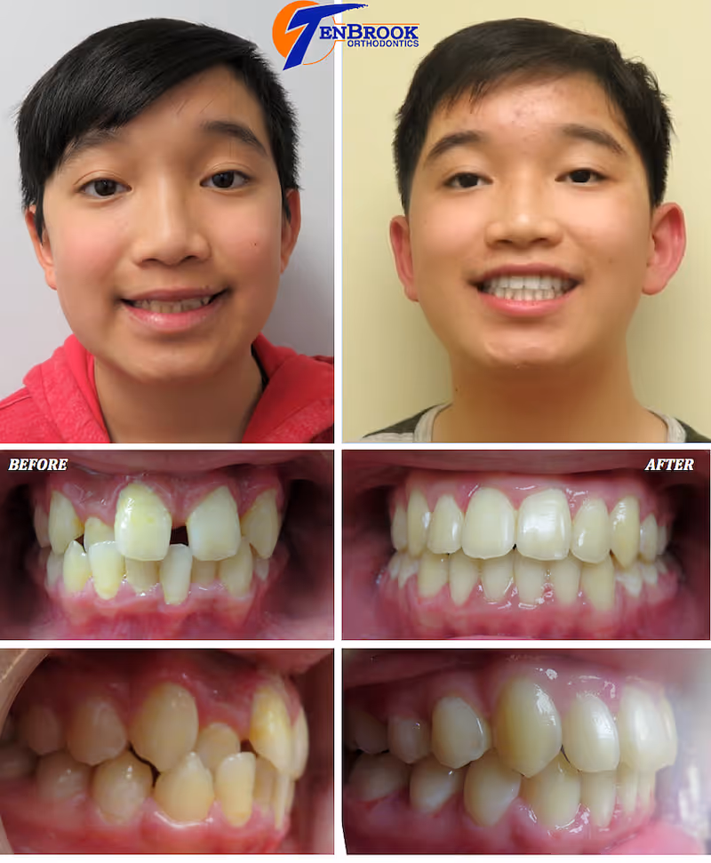Boy with Crossbite