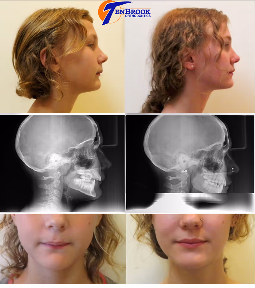 Facial Profile Change