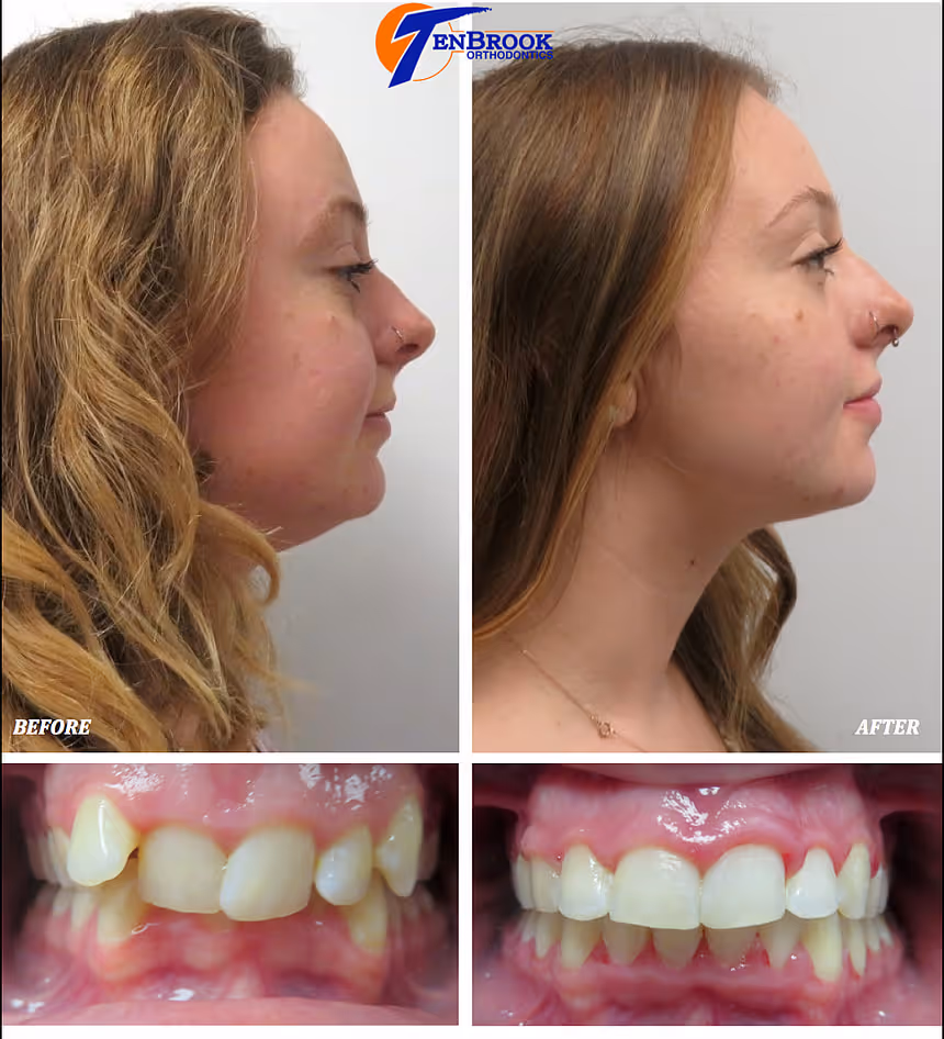 Facial Profile Change