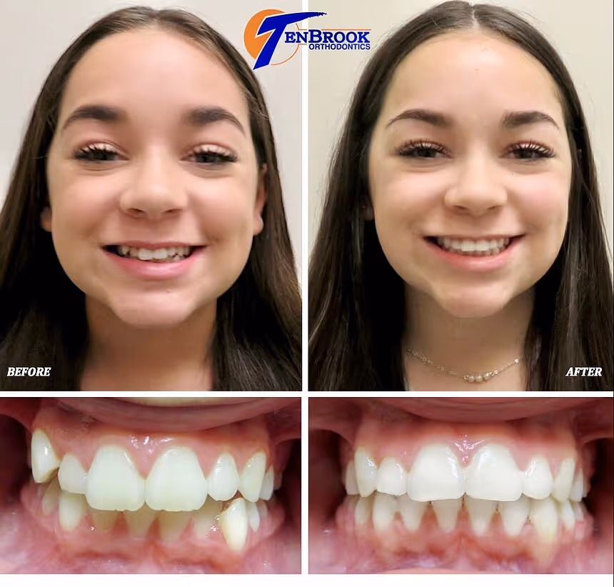 Mild Crowding & Overbite