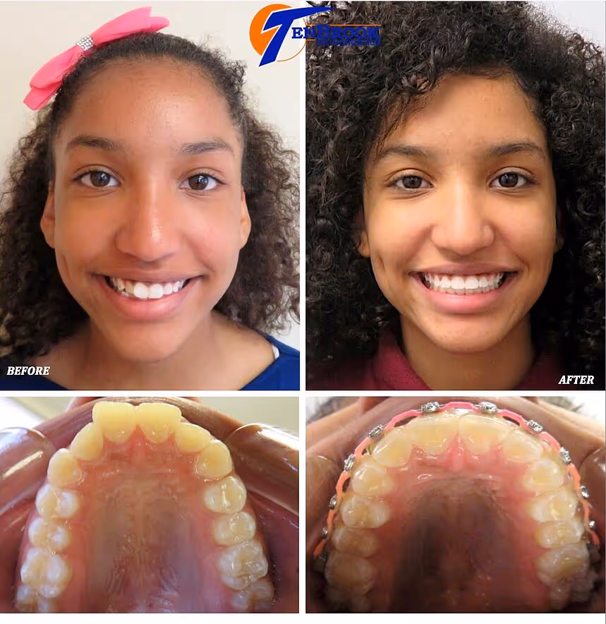 Overbite with Archform Expander