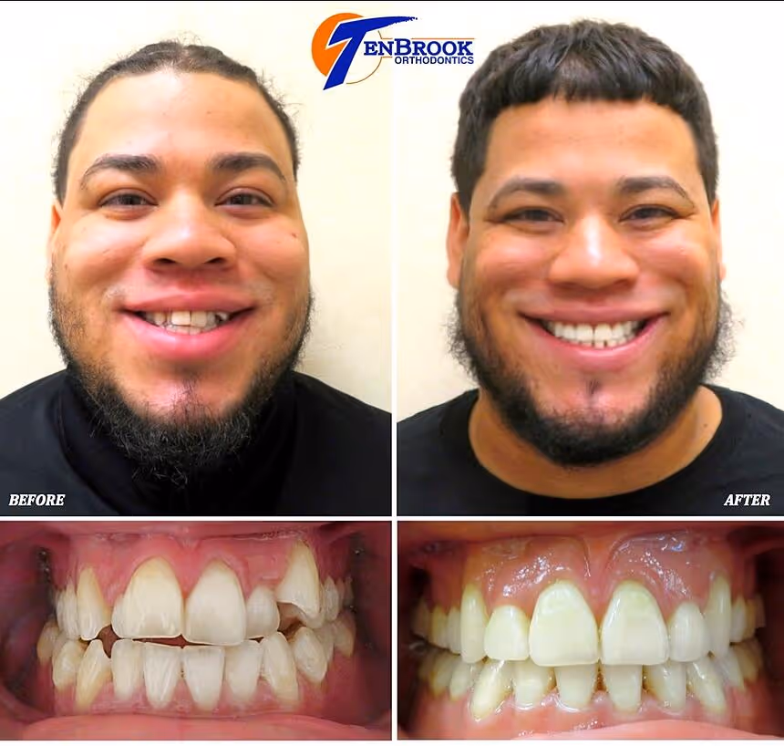 Open Bite & Severe Crowding