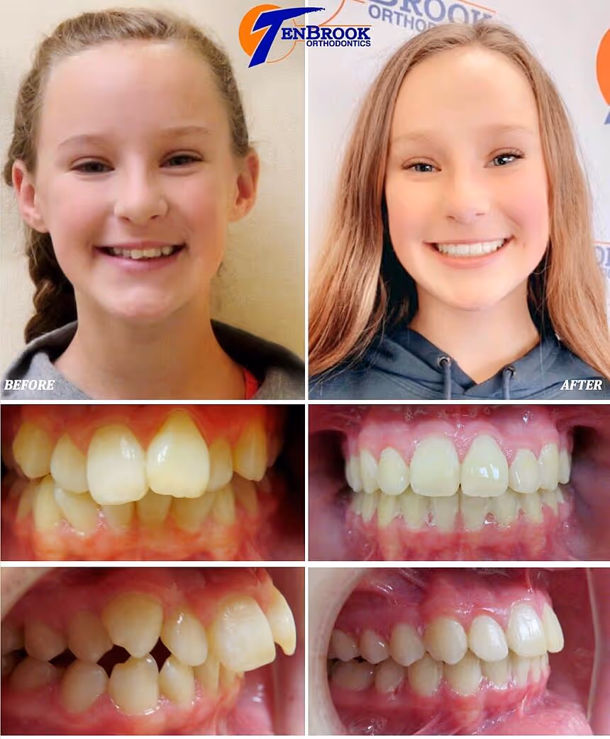 Overbite with Crowding