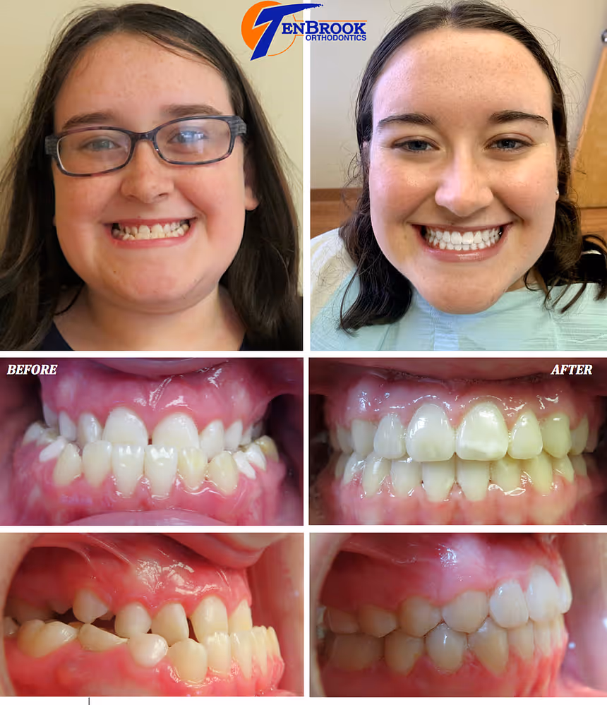 Woman with Underbite