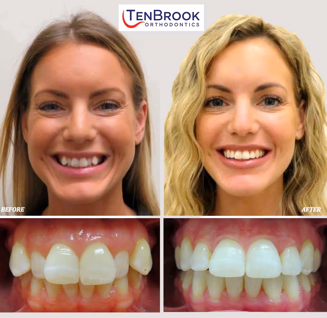 The TenBrook Orthodontics Smile