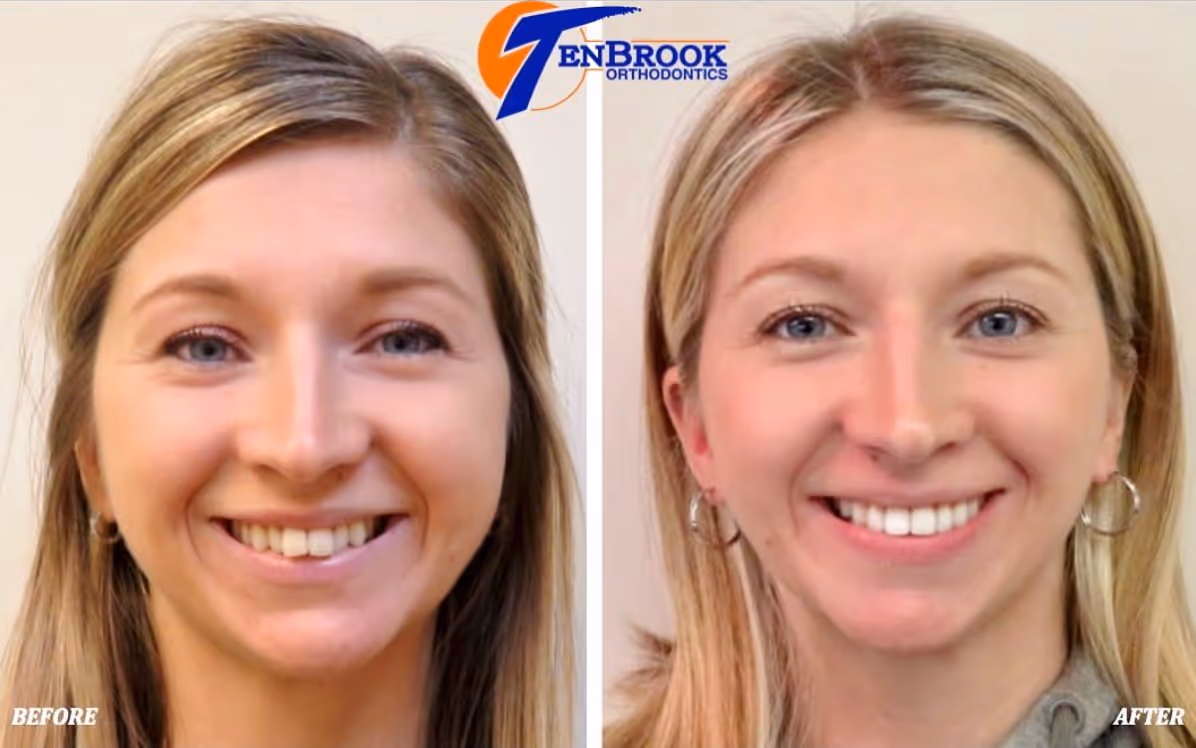 Adult Braces: Debunking Popular Myths & Misconceptions