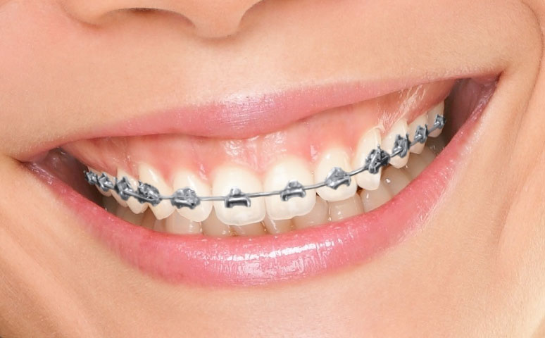 Fastbraces on Teeth