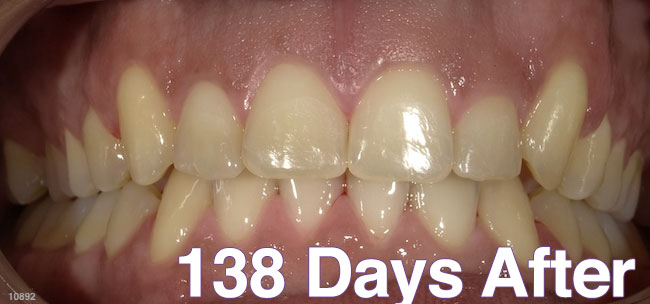 After Treatment