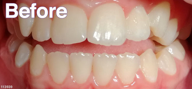 Before Treatment