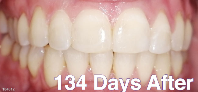 After Treatment