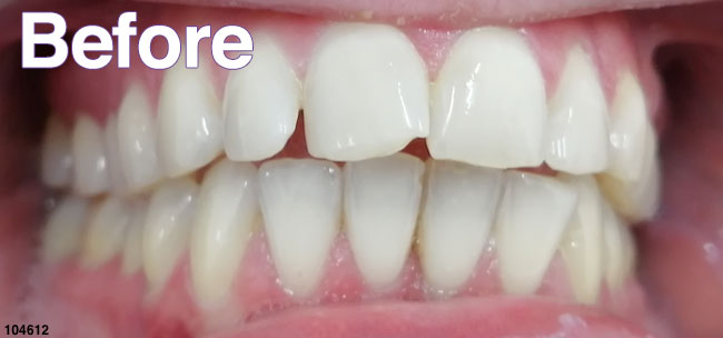 Before Treatment