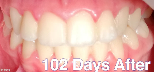 After Treatment
