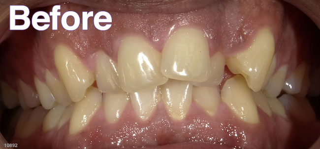 Before Treatment