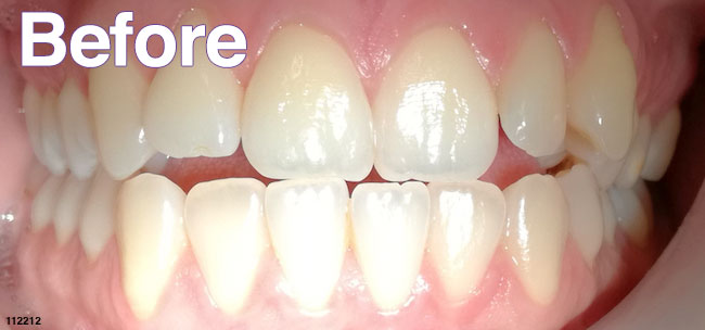 Before Treatment