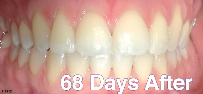 After Treatment