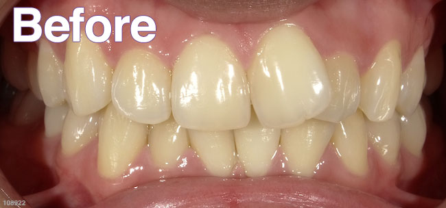 Before Treatment