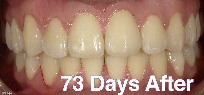 After Treatment