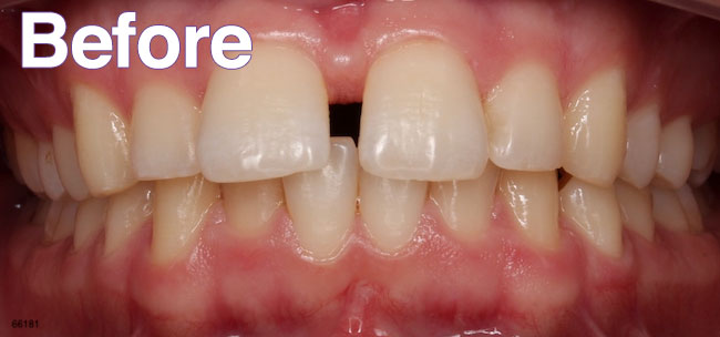 Before Treatment