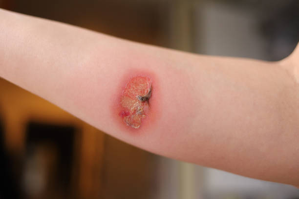 Arm with a inflamed wound. 
