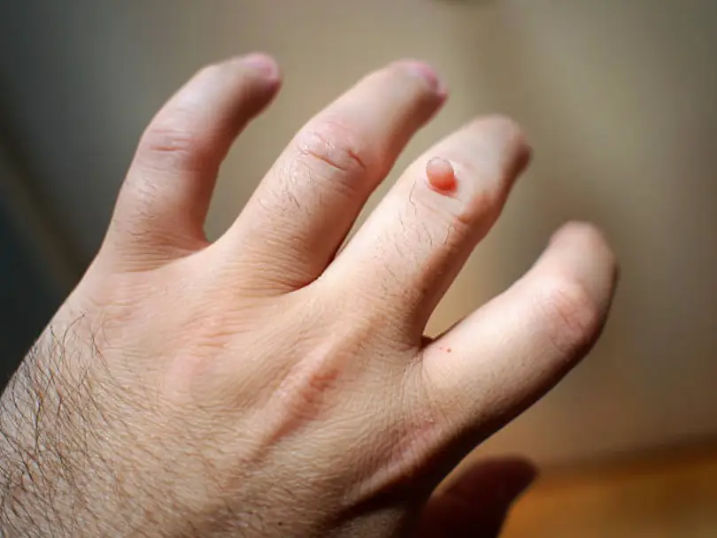 Common wart on the finger showing a raised, flesh-colored growth on the skin.