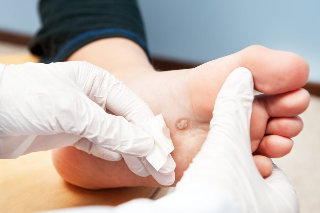 Plantar wart on the bottom of the foot being examined by a gloved healthcare provider.