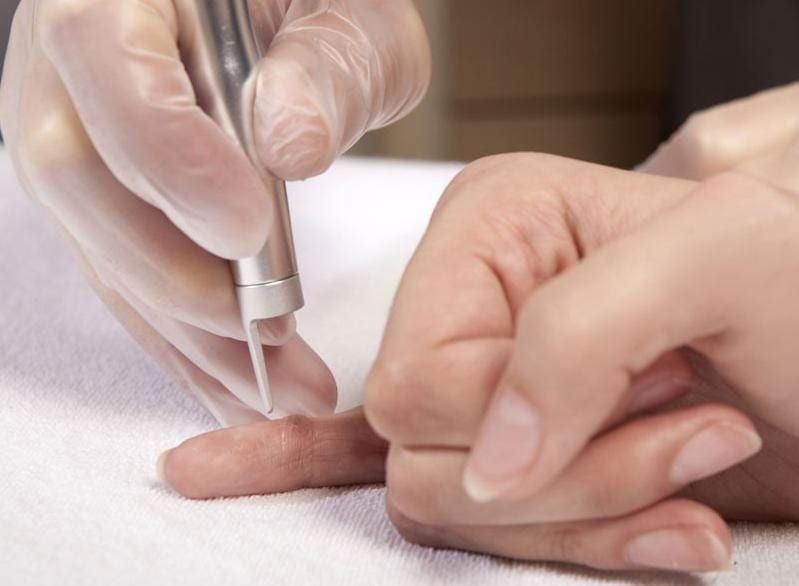 Dermatologist performing wart removal on a finger using a medical instrument.