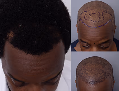 Before, hair transplant planning, and after results for Afro hair restoration showing improved frontal hairline density.