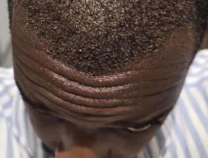 Close-up of a healed Afro hair transplant showing natural hairline growth and restored hair density.