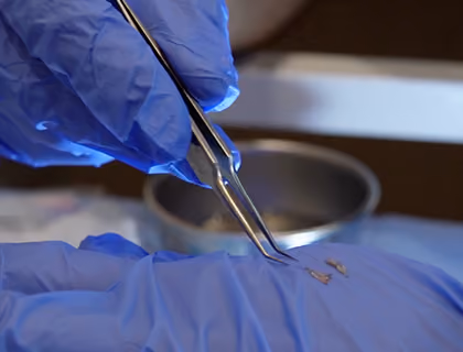 Close-up of a hair transplant specialist using forceps to prepare and handle individual hair grafts during a restoration procedure.