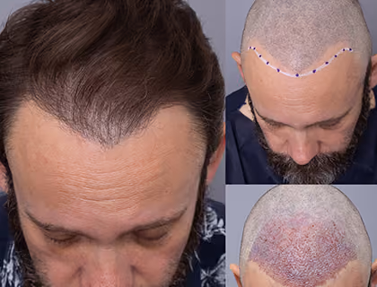Before, hairline design, and after results of a male hair transplant showing restored frontal hair density.