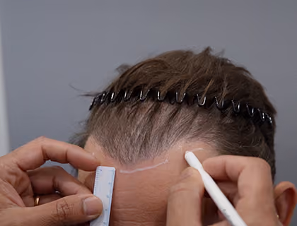Hair transplant specialist marking a female patient's new hairline before a hair restoration procedure.